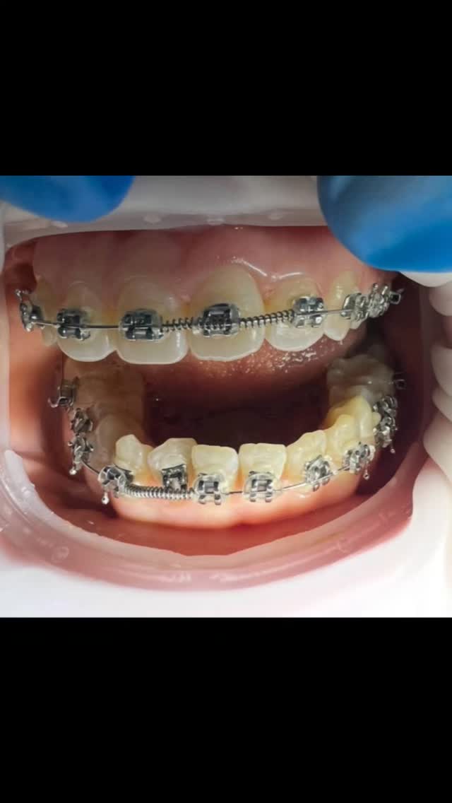 Эстетическая пломба