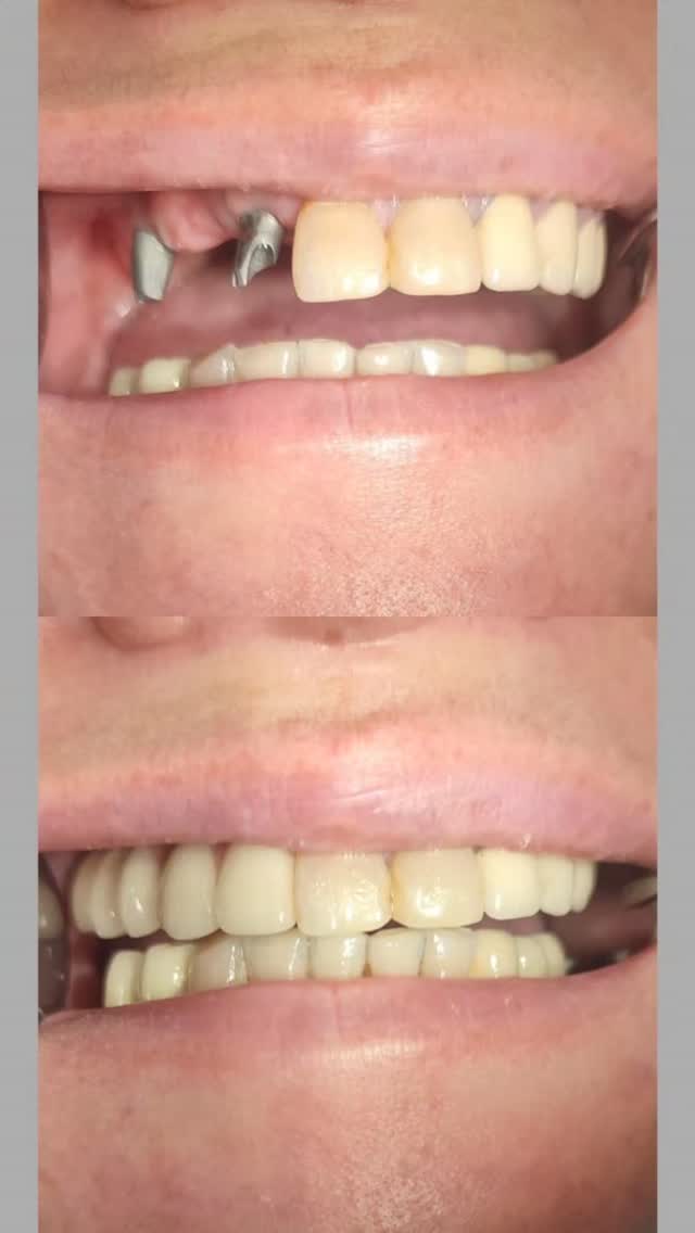 Ортодонтия (брекеты)